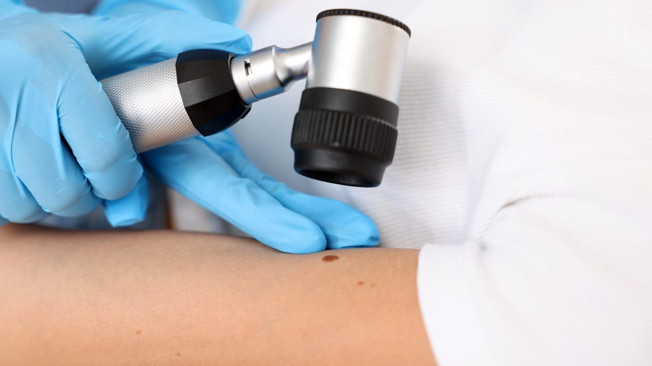 Doctor examining young woman's mole with dermatoscope in hospital, closeup
